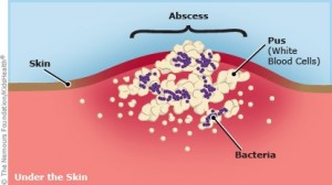 abscess